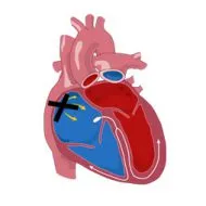 интравентрикулен проводимостта на сърцето, intraatrial