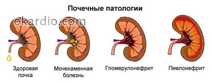 Нарушаване на интравентрикулен проводимостта на сърцето, че е