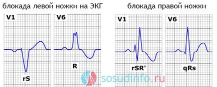 интравентрикулен проводимостта на сърцето, intraatrial