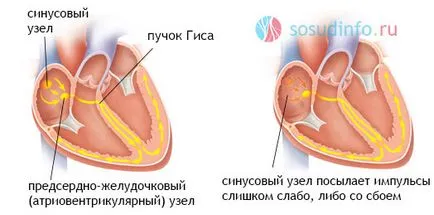 интравентрикулен проводимостта на сърцето, intraatrial