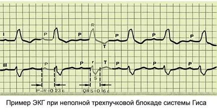 Нарушаване на интравентрикулен проводимостта на сърцето, че е