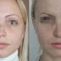 Операция rhinoseptoplasty носа цени, снимки, видео, коментари