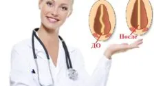 Операция rhinoseptoplasty носа цени, снимки, видео, коментари