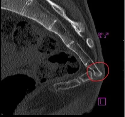 Coccyx fájdalom, mint a kezelésére