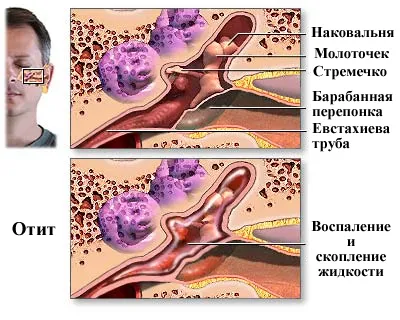Остра инфекция на ушите