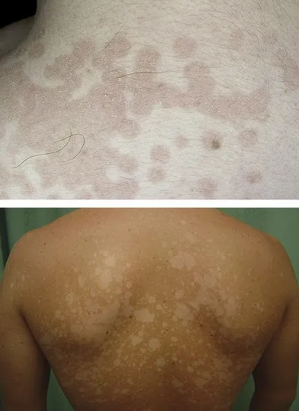 Chromophytosis диагностика, лечение, таблетки, мехлеми, boltushkamizyamizyami, Chatterbox