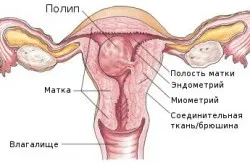 Плацентарната полипи причини, симптоми и лечение