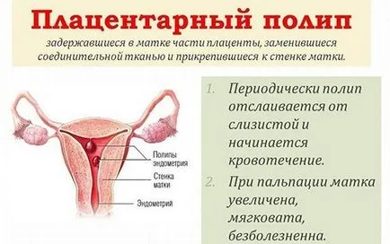Плацентарната полипи причини, признаци, симптоми и лечение