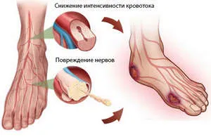 долните крайници полиневропатия (сетивни, аксонално) симптоми и лечение лекарства, и (разбира) долните крайници полиневропатия (сетивни, аксонално) симптоми и лечение с лекарства и
