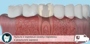 След лечение на пулпит зъбобол и болезнени усложнения nakusyvat