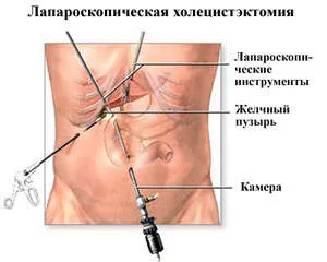 Причини за възникване на полипи в жлъчния мехур, неоплазми и лечение diagonstirovanie на (жлъчката) Причините за полипи в жлъчния мехур, diagonstirovanie и лечението на тумори