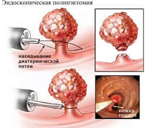 Причини за полипи в жлъчния мехур, неоплазми и лечение на diagonstirovanie (пикочния мехур) Причините за полипи в жлъчния мехур, diagonstirovanie и лечението на тумори