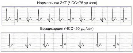 Синусова аритмия на сърцето причинява, диагностика и лечение