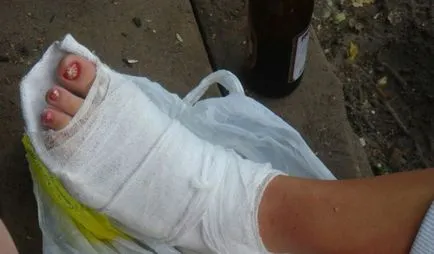 Как да ходим в гипсова отливка със счупен крак