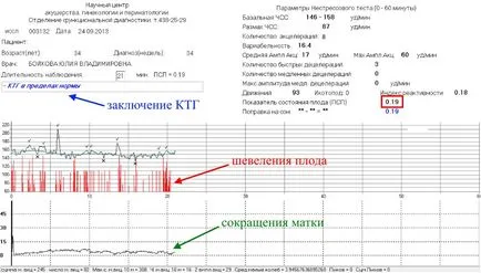 Hogyan megfejteni az eredménye CTG Hogyan megfejteni az eredménye CTG