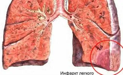 Белодробна емболия прогноза, каузи, клинична и първа помощ