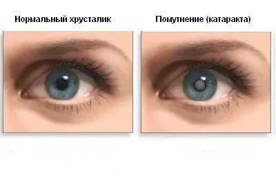 Мъгла в очите на причините и лечението