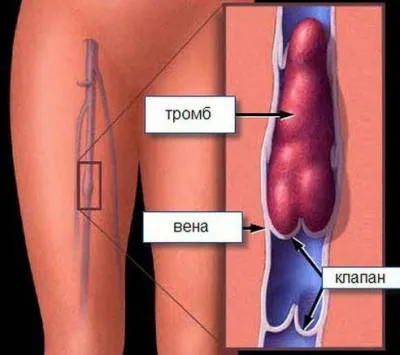 Белодробна емболия прогноза, каузи, клинична и първа помощ