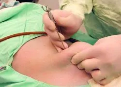 Отстраняване на миома на матката - коремна хирургия
