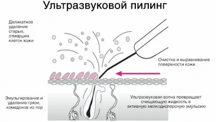 Ултразвуково почистване на лицето, че е, противопоказания ултразвуков пилинг