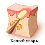 Видове акне, медицинска клиника