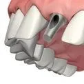 Protézis vagy implantáció Protézis vagy implantáció