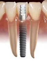 Protézis vagy implantáció