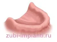 Protézis vagy implantáció Protézis vagy implantáció