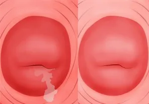 Хронична metroendometritis какво е неспецифичен и неактивно ендометрит