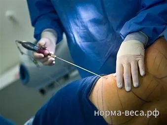 Хирургично лечение на наднормено тегло, така че бариатрична хирургия (липосукция) Хирургично лечение на затлъстяване, което е бариатрична хирургия