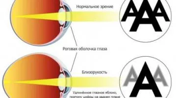 Vision минус 1, което означава, село визия за това какво да правя, рязко защо, от компютър, миопия (поглед) Vision минус 1, което означава, село визия за това какво да правя, рязко защо, от компютър, късогледство