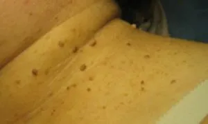 От това, което се появи на папиломи по шията