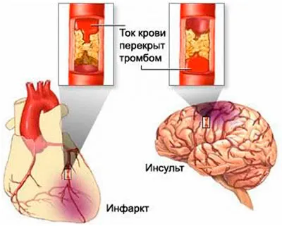 Какво е различен от инфаркт инсулт
