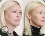 Пилинг мнения на кожата Пилинг мнения на кожата