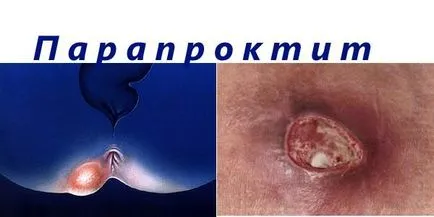 Тъй като има фистула Тъй като има фистула