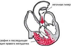 Право камерна хипертрофия какво е
