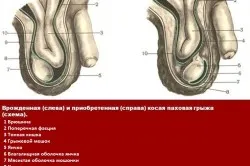 Какво е херния тестис