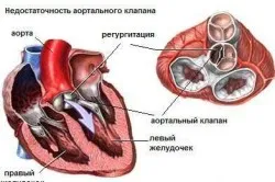 Право камерна хипертрофия какво е