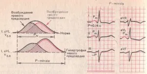 Право камерна хипертрофия какво е