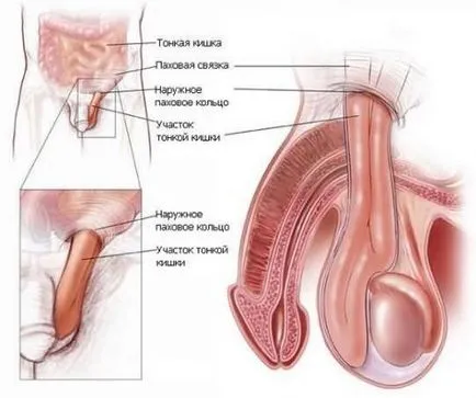 Какво е херния тестис