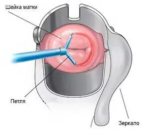conization какво е