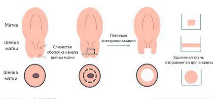 conization какво е