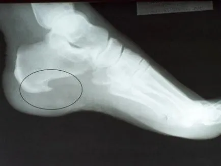 Лечение на петата разклонения Dimexidum
