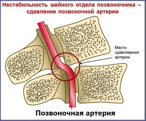 Нестабилността на шийните прешлени лечението на