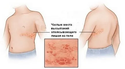 Херпес зостер херпес зостер лечение