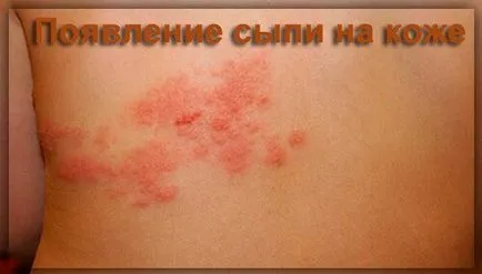 Херпес зостер херпес зостер лечение