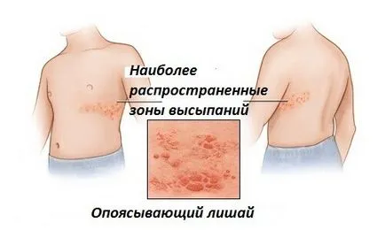 Херпес зостер херпес зостер лечение