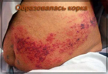 Херпес зостер херпес зостер лечение