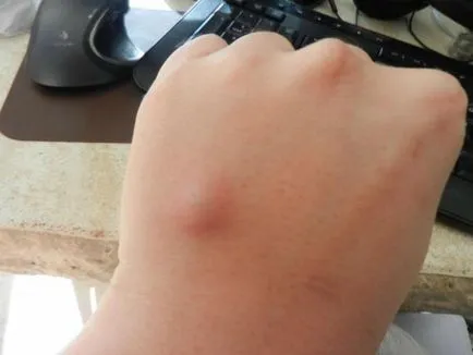 Пъпки по тялото от това, което