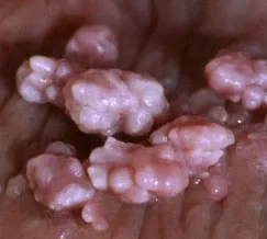 Как да получите HPV